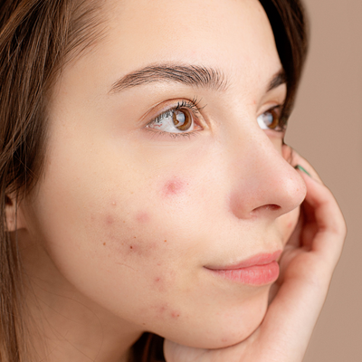 Soin du visage pour peau acnéique chez une esthéticienne la Wantzenau